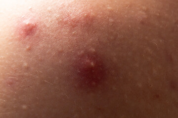 Fototapeta premium Skin problem background with infected bumps and acne. Inflamed skin bumps acne macro. Close up acne on skin. Irritated acne skin.