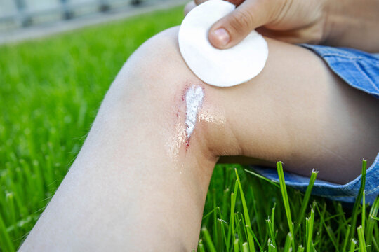 Cleaning a child's injured knee with a cotton pad and hydrogen peroxide