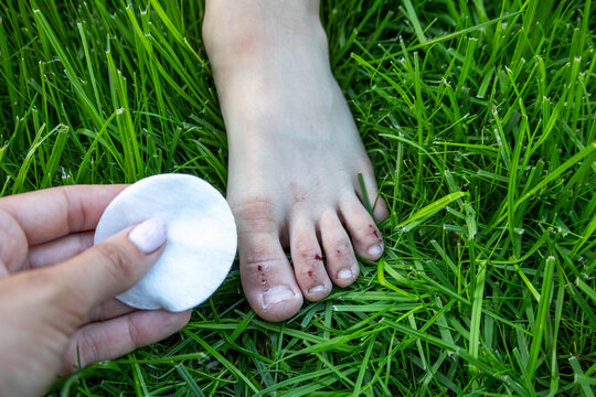 Treating a child's scratched toes with antiseptic on green grass