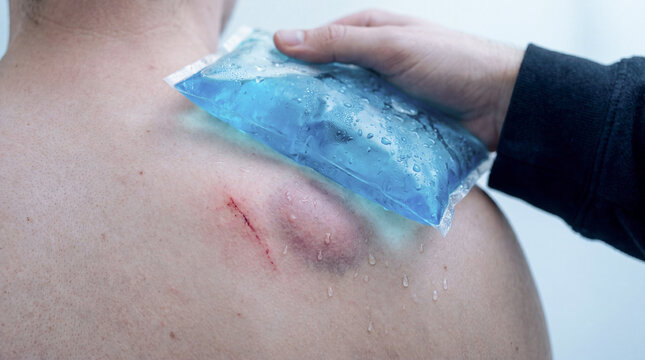 Applying cold pack to injured shoulder, recovery from sports injury