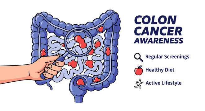 Educational illustration for colon cancer awareness, featuring a human hand with a magnifying glass examining the colon, with icons for screening, diet, and exercise to promote healthy living.