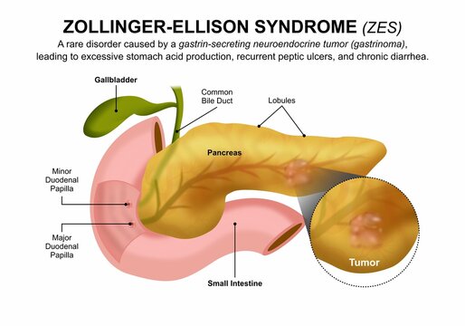 Zollinger-Ellison Syndrome (ZES) Flashcard Illustration