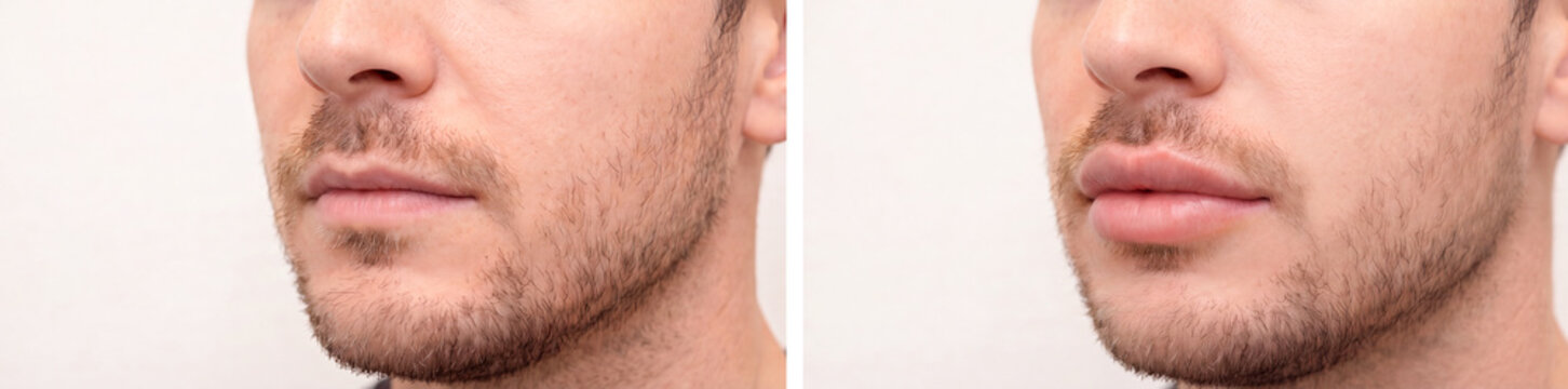 Male Lip Filler Before and After, Close-Up of Man's Lips Showing Augmentation Results
