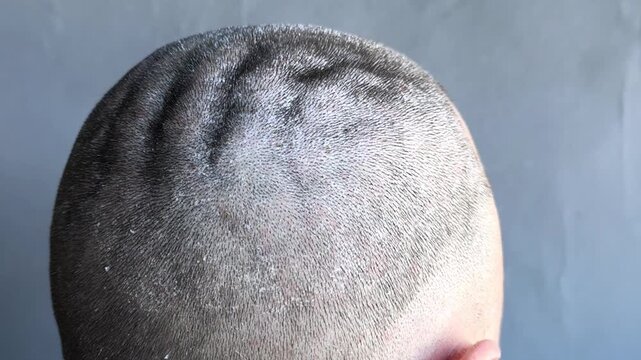 detailed view of seborrheic dermatitis on scalp, showing irritated skin with visible flakes and red patches. discomfort, requires appropriate treatment to manage symptoms. dandruff and itching.