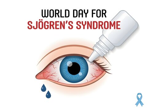 World day for sj gren's syndrome awareness illustration of dry eye and artificial tears application