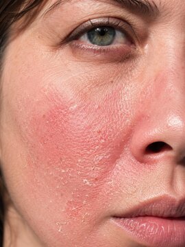 Close-up of adult woman with red irritated dry skin and flakes on cheek in natural light