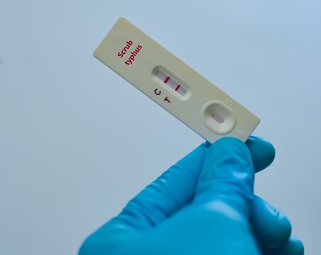 Blood sample of patient positive result for scrub typhus.