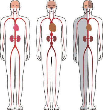 人体の血管障害などによる疾患。半身麻痺や脳、心臓、腎臓の病気のイラスト。
