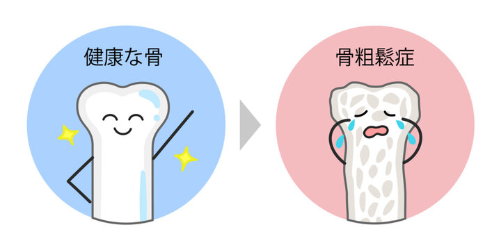 健康な骨と骨粗鬆症の骨の比較イラスト