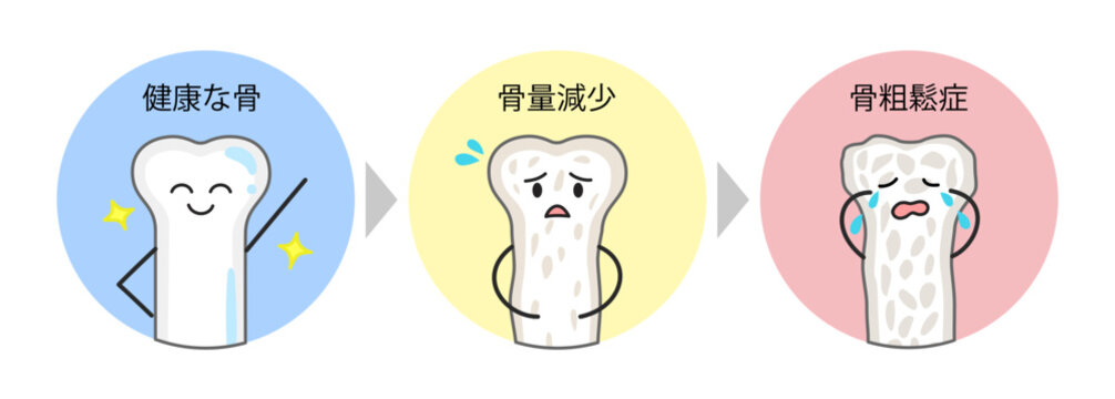 健康な骨と骨量減少と骨粗鬆症の骨の比較イラスト