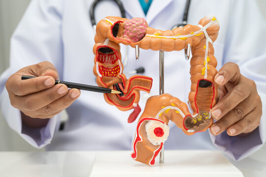 Colorectal cancer, doctor holding intestine colon human anatomy model.