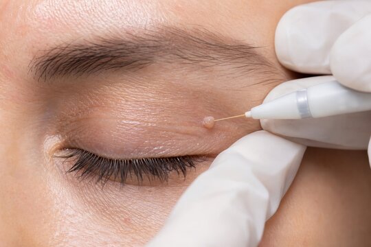 Dermatologist removing mole on eyelid of young woman using laser device. Laser skin treatment for papilloma removal. Professional aesthetic clinic procedure for facial skin rejuvenation.