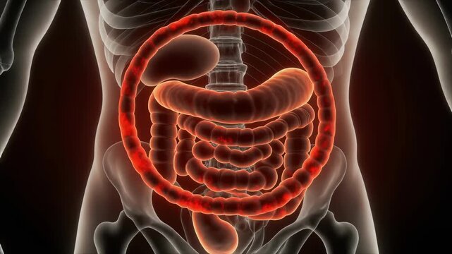 Mesenteric Fat Ring Shown in CT Style Inflammatory Haze for Medical Education