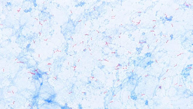 Mycobacterium tuberculosis Acid Fast Bacilli in Ziehl Neelsen Stained Sputum Smear Microscopy
