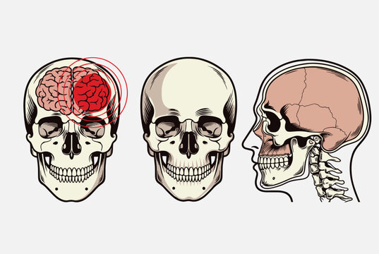 Anatomical skull views including a front view with a brain lesion and a profile view of the human cranium structure.