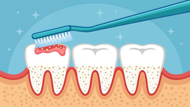 Dental hygiene illustration showing a toothbrush cleaning inflamed gums and plaque buildup on white teeth preventive oral health concept toothbrush dentistry cleaning treatment preventive