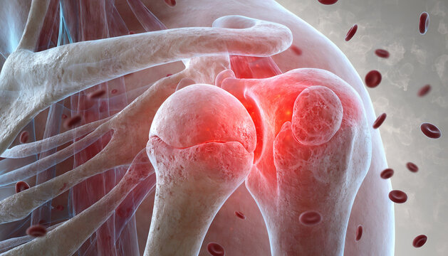 3D anatomy illustration of the knee joint showing osteoarthritis with cartilage degeneration