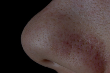 Fototapeta premium Nose Skin with Pores and Redness Close Up