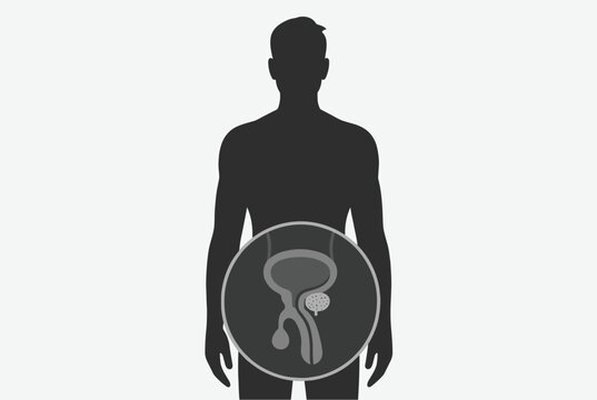 Anatomical diagram within a male silhouette highlighting the prostate gland for urology and mens health awareness topics.