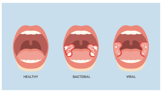 Medical illustration comparing a healthy human throat with throats infected by bacterial and viral tonsillitis showing swelling and white spots.