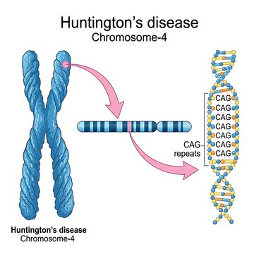 Genetic diagram showing huntington's disease mutation on chromosome