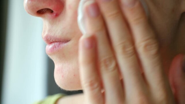 Close up female face with red pimples, allergic rash, carefully applying medical treatment with cotton pad to sensitive skin, focusing on dermatological care. Woman treating facial skin allergy rash
