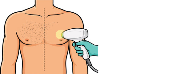 Man chest hair removal with laser treatment, before and after comparison. © ayub