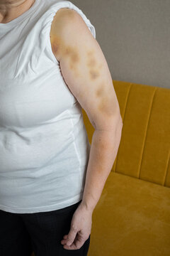 Woman showing multiple bruises and hematomas on her arm, indicating physical injury and potential domestic violence or abuse, against a minimalist background