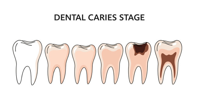 Educational diagram illustrates the progressive stages of dental caries from a healthy tooth to severe decay and pulp infection.