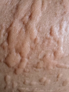 Closeup of urticaria hives skin rash with raised wheals