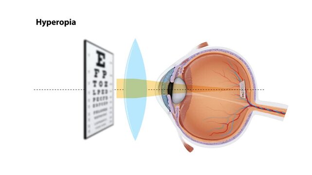 Hyperopia Vision Correction Animation Farsightedness Eye Anatomy, Convex Lens Refraction, Ophthalmology Medical Diagram, Human Eye Focus Mechanism, Optometry Education 2d
