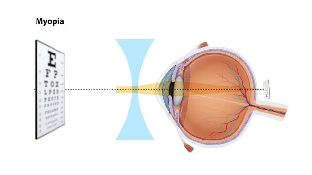 Myopia Correction Animation Nearsightedness Vision Disorder, Concave Lens Refraction, Human Eye Anatomy, Ophthalmology, Optometry, Medical Education, 2D and 3D Animation