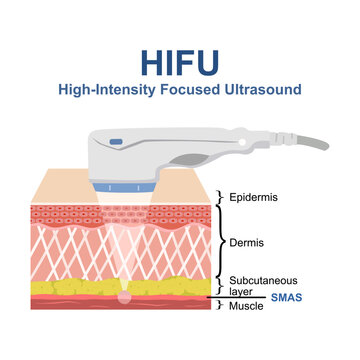 High intensity focus ultrasound (HIFU). SMAS ultrasound face lifting. Face saggy skin treat. Body lift. Double chin lift. Facial medical procedure. 3d flat isometric vector cutaway skin diagram.
