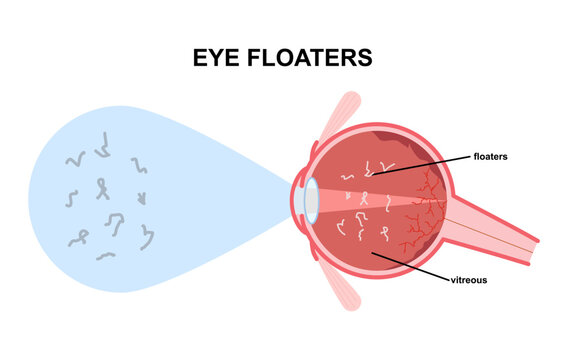 Eye floaters fluid vision retina myopia trauma surgery loss of light tear torn laser surgical repair older Detached blurry shadow Pain injury hole macular Age treat blood dark lose wear Pars Plana