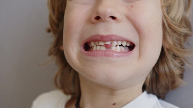 Six year old boy shows his wobbly upper baby incisor and changing teeth with developing bite and a supernumerary tooth