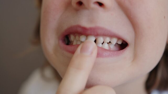 Six-year-old boy explores his changing mouth. He uses a finger to check his loose upper incisor milk teeth and identifies a supernumerary molar tooth growing
