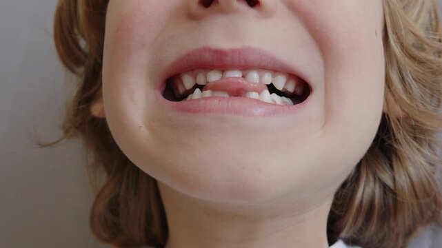 A six-year-old boy smiles, showing a slit with his tongue through which the upper milk incisor has fallen out. He also has a small extra tooth on his lower jaw, as his baby teeth are changing