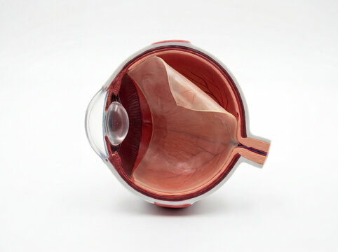 Detailed anatomical human eye model showing cataract lens and internal structures