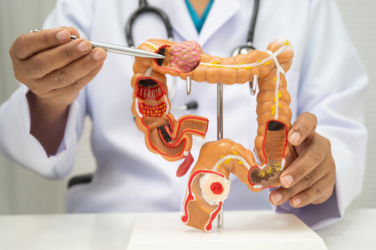 Colorectal cancer, doctor holding intestine colon human anatomy model.