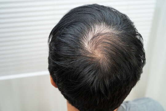 Bald in the middle head and begin no loss hair glabrous of mature man.