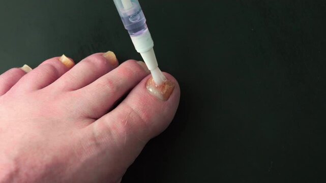 Foot shows discolored nail being treated with pen-like device. Foot appears slightly swollen and the toe nail indicating a fungal infection. Treatment tool applies substance to nail, likely for medica