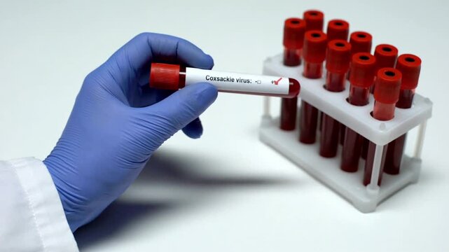 Positive Coxsackie virus blood sample in tube close up shot with unrecognizable doctor in biotechnology laboratory research in 4K Ultra HD footage.
