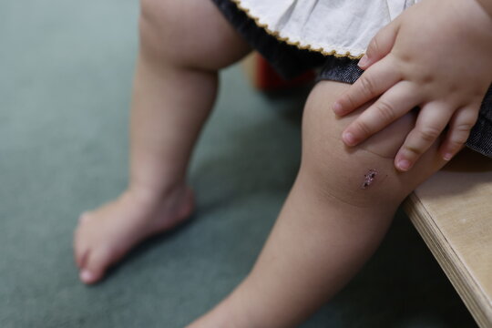 幼児の膝のかさぶた。子どもの怪我の治癒過程。クローズアップ