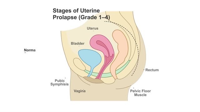 Stages of uterine prolapse (Grade 1-4) medical illustration showing progressive descent of the uterus through the vagina. Female pelvic anatomy educational concept. 4K animation, white background.