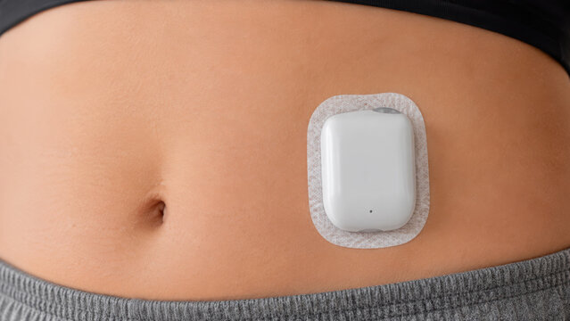 Close-up of a small white tubeless patch insulin pump adhered directly to an abdomen, .Wearable insulin delivery device concept.