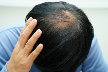 Naklejka premium Bald head in man, hair loss treatment health problem.