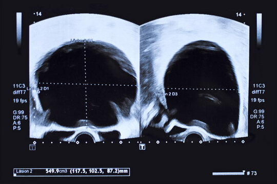 Ultrasound image of large round serous adenocystoma cyst in lower abdomen of woman printed on a piece of paper