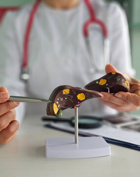 Doctor with human liver anatomy model. Liver cancer