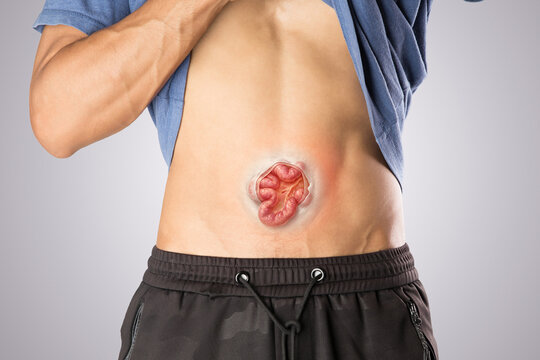 Illustration depicts hernia symptoms in a man's body. Common signs of a hernia are highlighted.