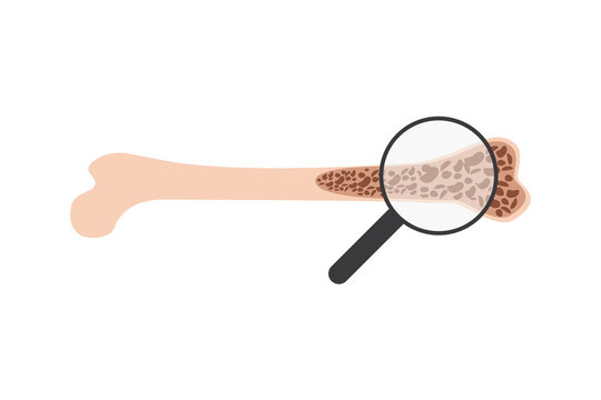Osteoporosis Bone Disease Vector Illustration. Porous Bone Anatomy Medical Diagram Isolated